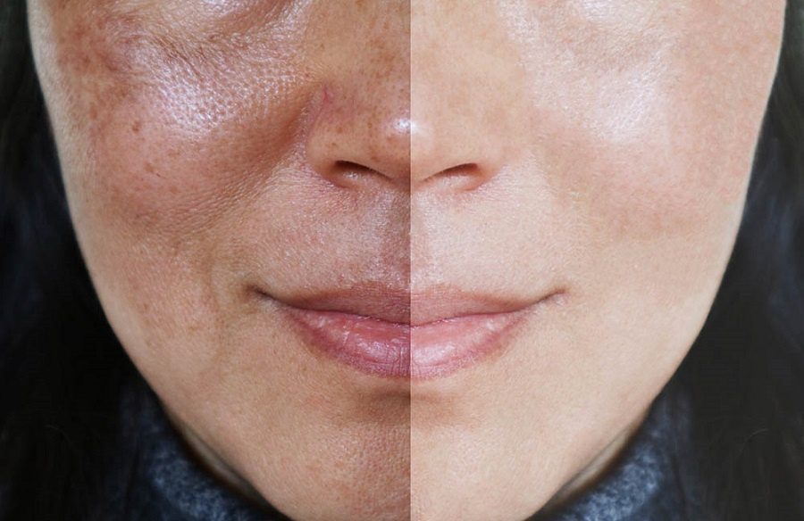 What is Melasma and Its Best Possible Treatment